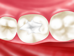 乳歯の虫歯は白い