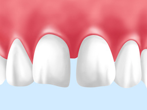 歯と歯の間にできやすい